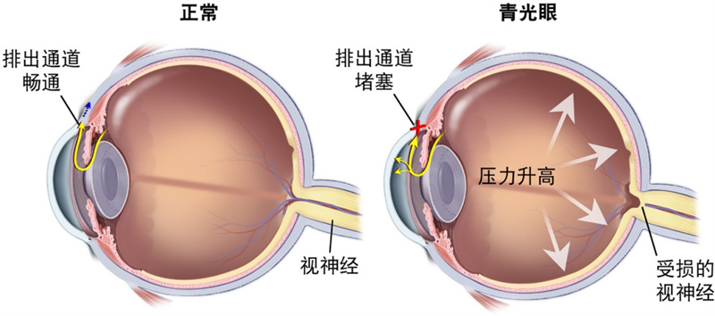 青光眼研究、治疗与预防的新突破及最新进展