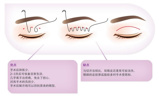 韩国最新埋线技术，重塑美丽的秘密武器